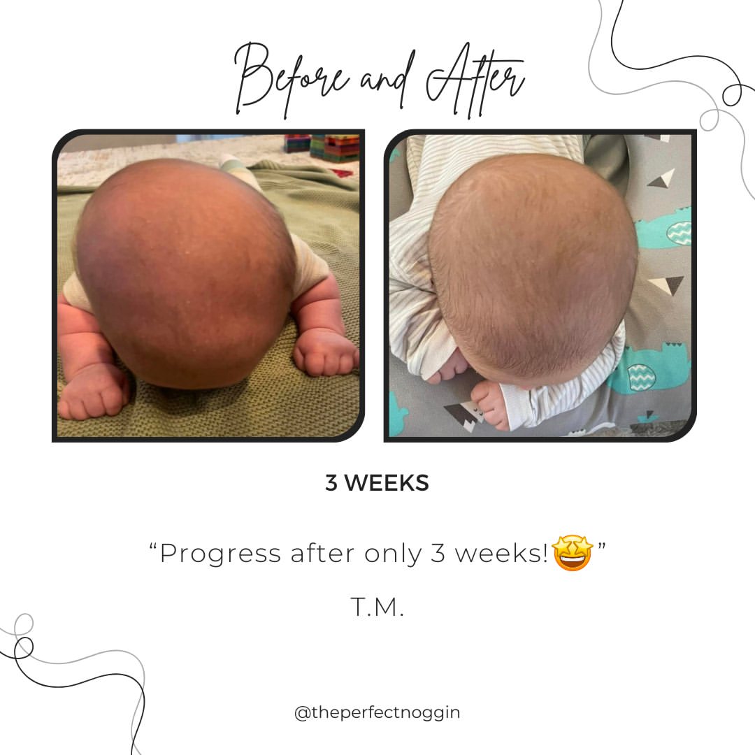 Perfect Noggin 2.0Plus Blemished model - Head Shaping Mattress